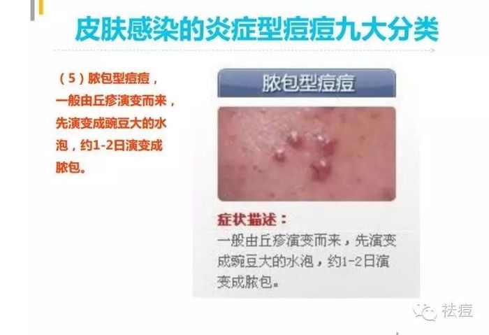 脓包型痤疮图片